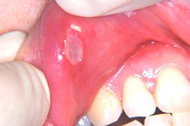 口内炎 原因 舌